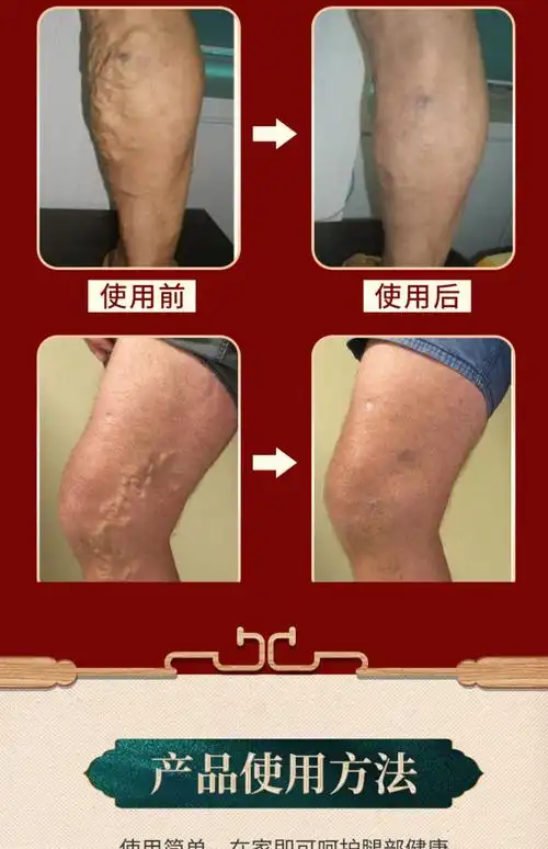 云南本草精索静脉曲张治疗型仪器脉舒冷敷凝胶 三盒疗程装(中度使用)