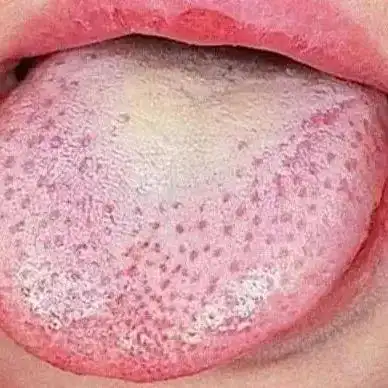 杨梅舌(2～3天后白苔最先 脱落,舌面平滑呈肉红色,并可有浅表破碎