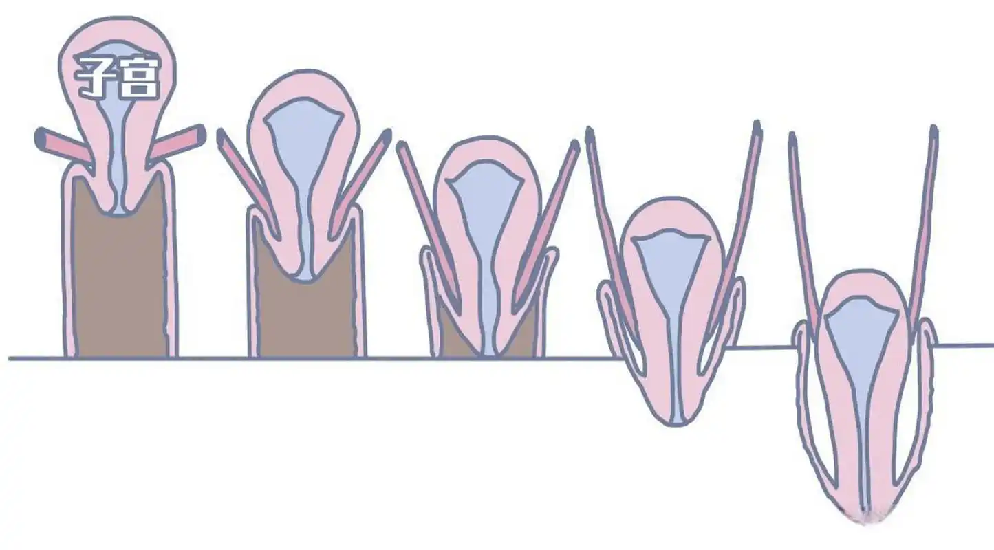 子宫脱垂复位后,为什么会反弹 ,真相是什么 现在子宫脱垂患者越来越多