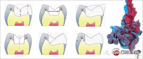 嵌体修复坎坷路