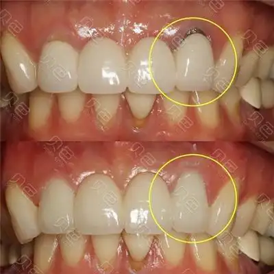 烤瓷牙修复前后对比
