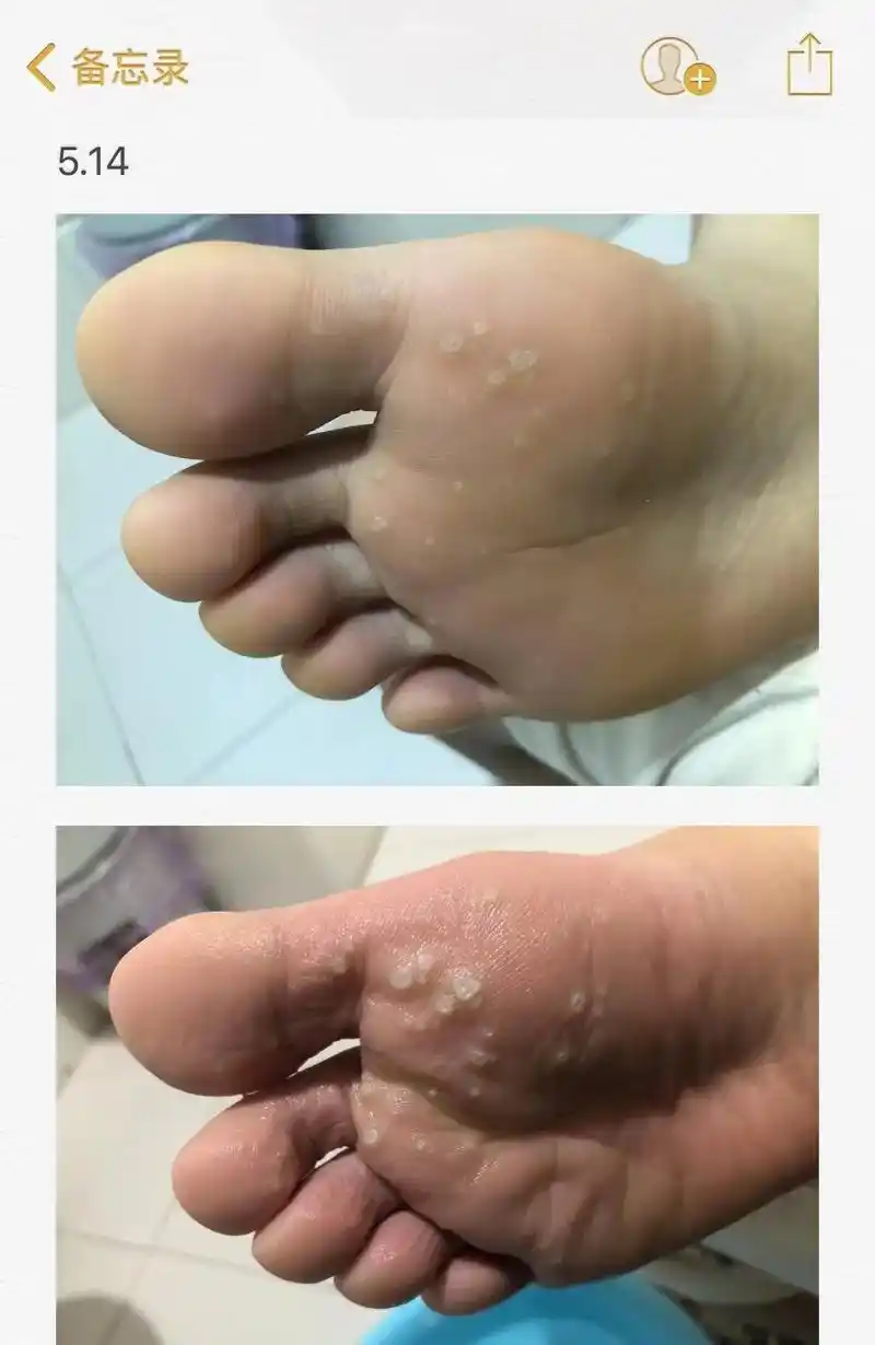 跖疣的蜕变.很早以前发现脚底长了一个茧子, 也没注意,以为是 - 抖音