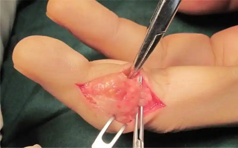 左手手指腱鞘囊肿手术图片_有来医生