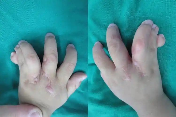 先天性并指多指畸形典型病例(手术实例) - 好大夫在线