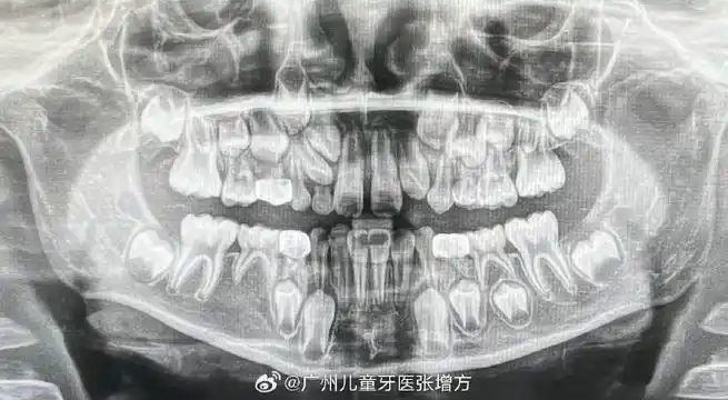 替牙期儿童拍摄全景牙片的意义