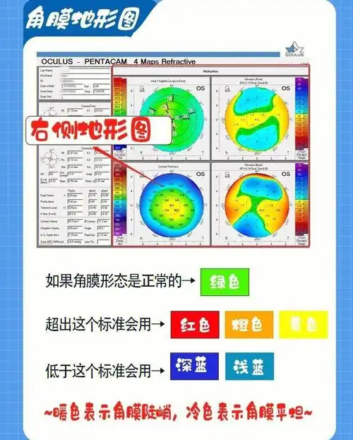 72近视手术必查的角膜地形图手把手教你认