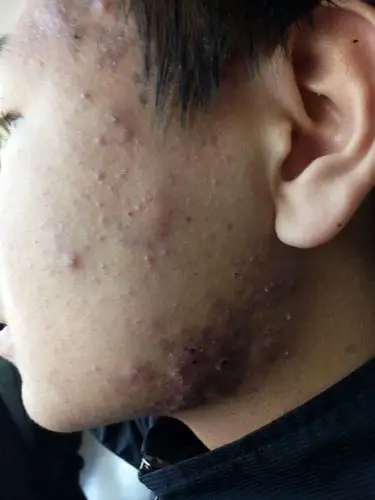 莒县中医医院皮肤科中西医综合治疗重度痤疮(越严重越欢迎就诊)