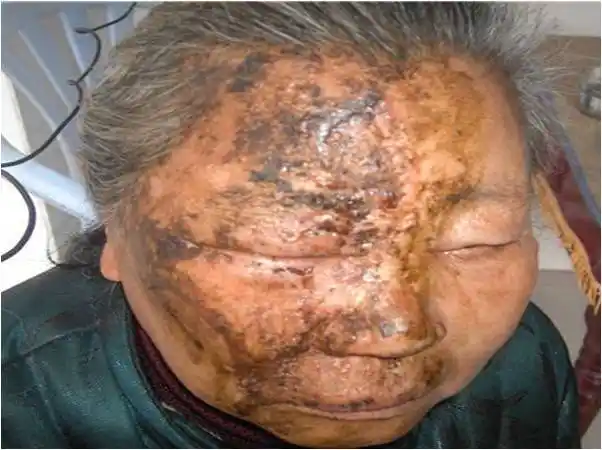 糖尿病皮肤病变_北京和为中医院