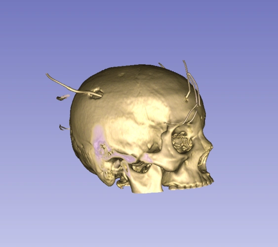 观察术后三维重建的颅骨骨孔内面观察,可见引流管紧贴颅骨引流管与