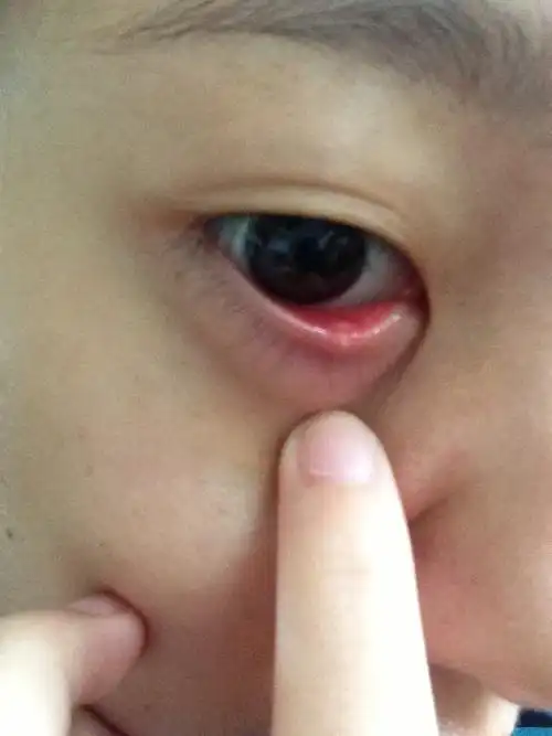 我这个眼睛算是长针眼了吗?