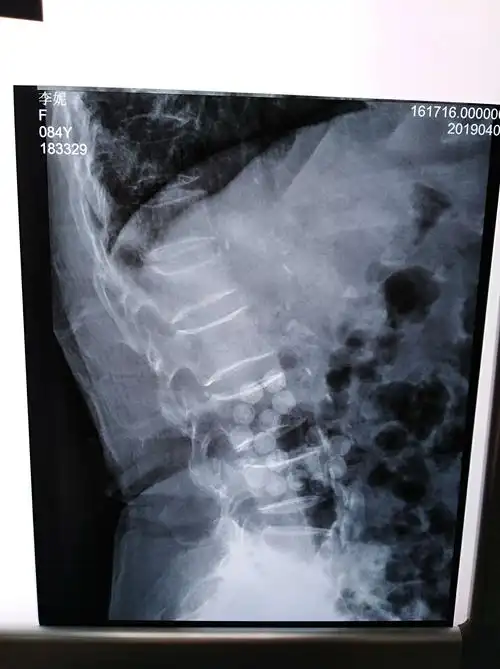 术前dr示腰1椎体压缩骨折