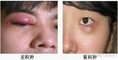 宝宝得了霰粒肿可以自愈吗宝宝得了霰粒肿好治吗