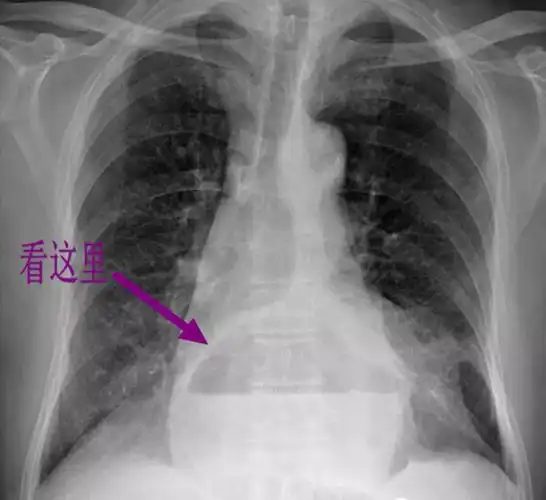 经典影像之食管裂孔疝 - 好大夫在线