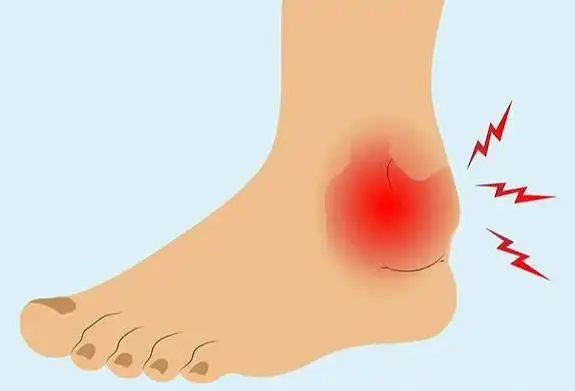 崴脚脖子,没您想象的那么简单,真的!