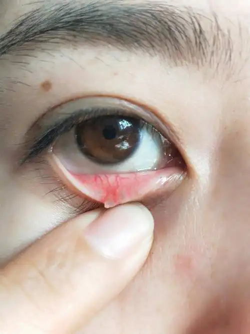 下眼皮上有硬块,挨着眼珠子,不碰不疼,怎么回事