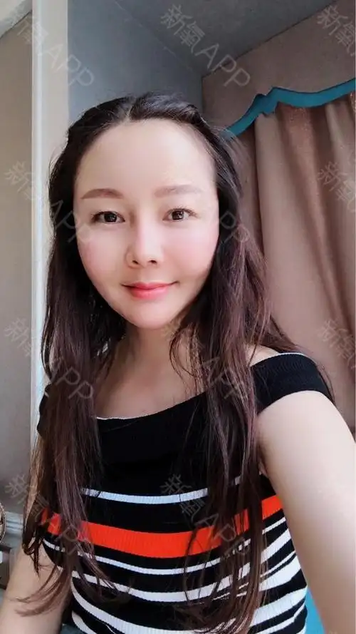 自体脂肪填充全脸