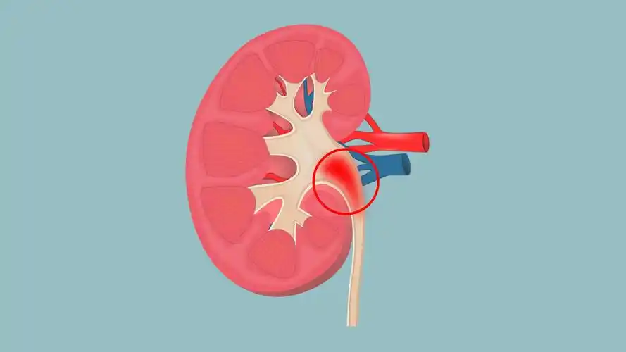 肾盂分离和肾积水区别