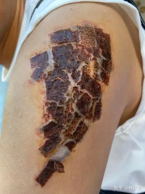 洗纹身恢复过程