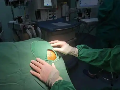 新技术不平凡的春节固始妇幼再次成功开展急诊脑出血微创钻孔引流术