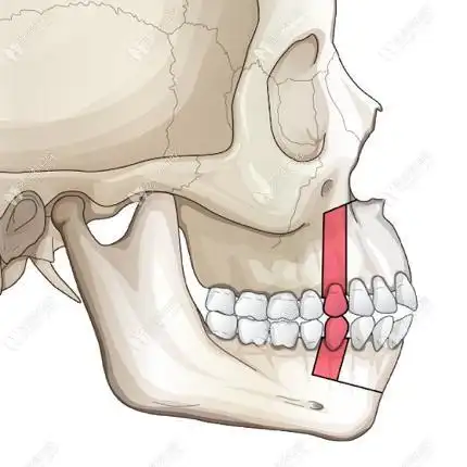 牙槽骨突出还能矫正吗?牙床突出戴牙套箍牙作用大吗?
