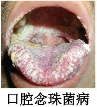 一张嘴就能看出是否得艾滋病?诊断艾滋病需要做什么检查?