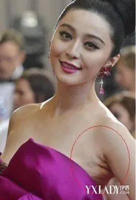 【图】腋窝旁边长副乳怎么去除 四大方法教你正确消除副乳