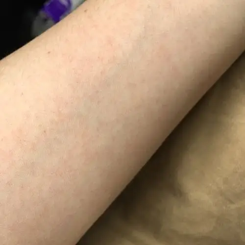 今天学车的时候晒了一会儿太阳,手臂上就布满了这样的红斑斑,不痒