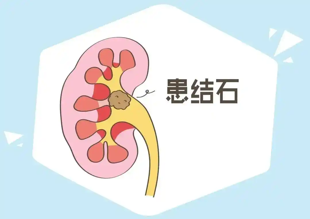 肾结石是怎么形成的呢?该怎样去预防!