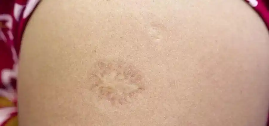 如今卡介苗作为预防药物,链霉素作为治疗药物,肺结核基本都可以治愈