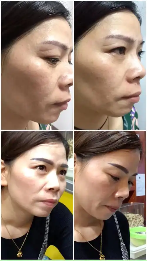 祛斑前后的对比