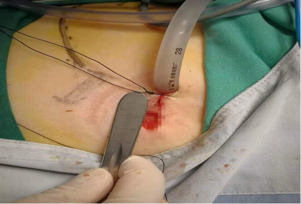 活检病理诊断确定为"右肺上叶鳞状细胞癌(中央型)",排除相关手术禁忌