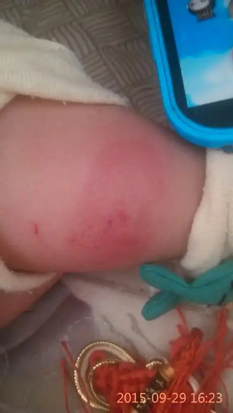 宝宝小腿上起了一个红包,有点硬硬的而且还会流一些淡黄色的水,这是