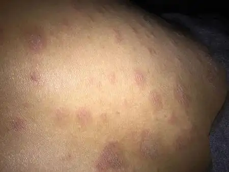 这是癣,去医院或者药房买癣药水都可以.