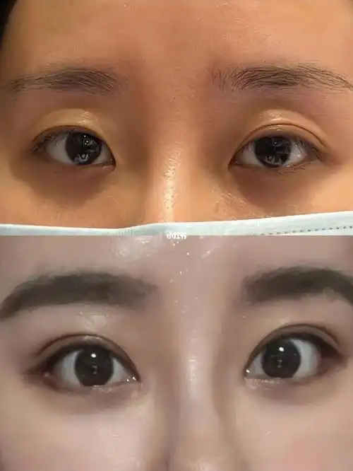 双眼皮不会显老凹才会