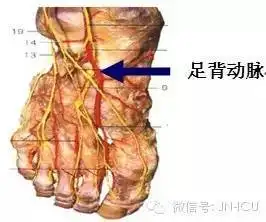 与皮肤呈45-60°,用已消毒的手指触及足背动脉搏动准确定位,使动脉恰