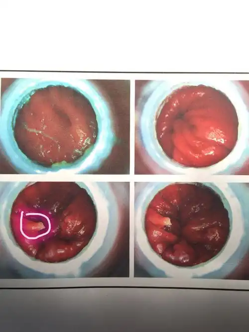 请问图片中圈起来的那个白色头的东西是肛乳头还是息肉啊