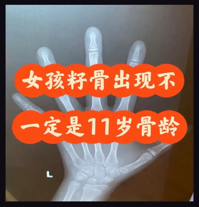 谨慎:女孩籽骨出现不一定是11岁骨龄.案例:女孩,生日:20 - 抖音
