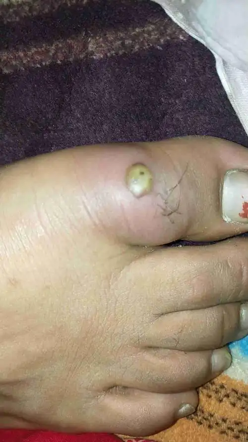 脚趾上有个大疙瘩?
