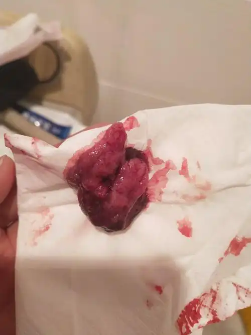 怀孕五周一晚上肚子疼然后出来这个是不是流产了