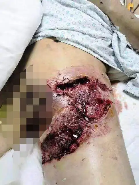 严重车祸司机左腿股动脉静脉断裂8小时命和腿保哪个