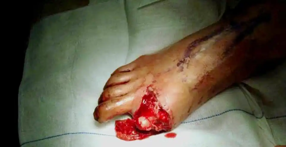 长航东院骨科:深夜紧急手术 救治深山患者_手机搜狐网