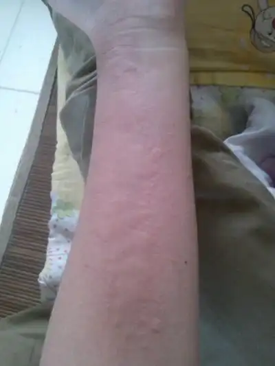 东城风疹医院_东城治疗风疹哪家医院好_东城治疗风疹最好的医院/排行