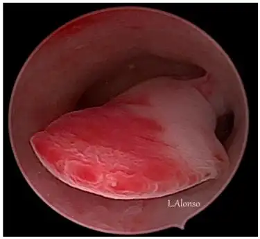 【镜·界】子宫内膜息肉的宫腔镜分型