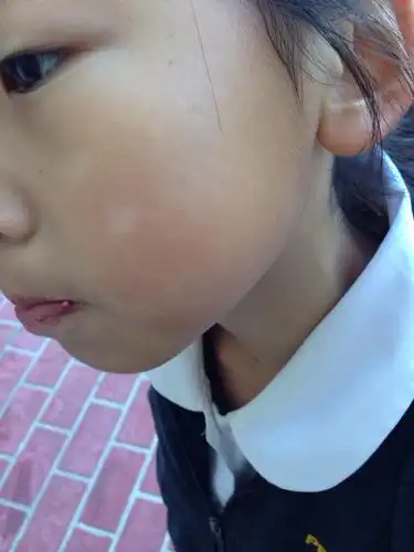 科2014-05-29 06:54 答: 你好,长在小孩脸上的白斑首先考虑是单纯糠疹