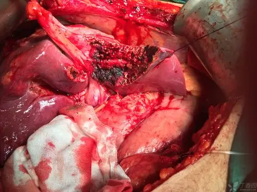 复杂肝包虫切除术一例 [病例帖]