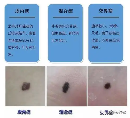 手贱抠破痣竟成黑色素瘤这几种痣要当心