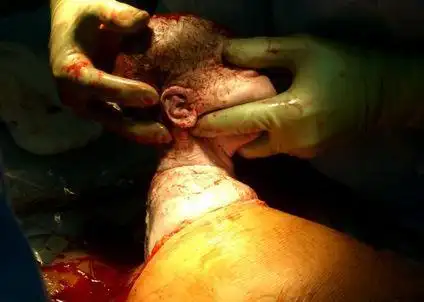 大约在手术刀口结疤二至三周后,疤痕开始增生,此时局部发红,发紫,变硬