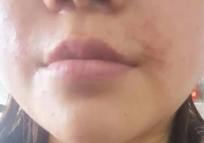 脱毛膏灼伤唇部