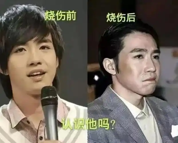 与俞灏明有些类似,戏骨谢君豪也在拍戏后,因为烧伤沦为了配角.