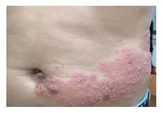 疱疹|皮疹|水痘|带状|性疾病|神经痛|东莞市_网易订阅